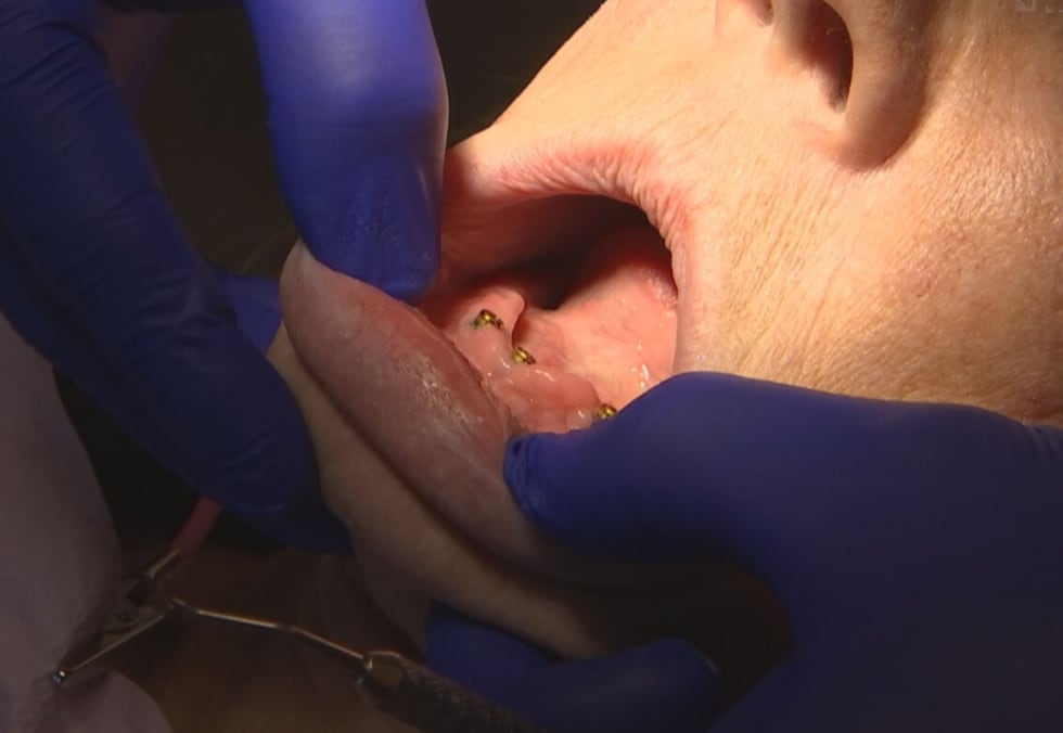 This is a photo of Ginger Peter's mouth which shows her dental implants the bottom gums of her...