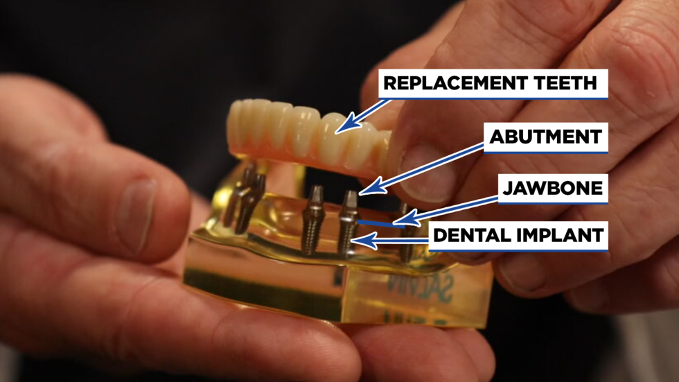 A graphic shows that dental implants are composed of 3 parts: replacement teeth, an abutment...