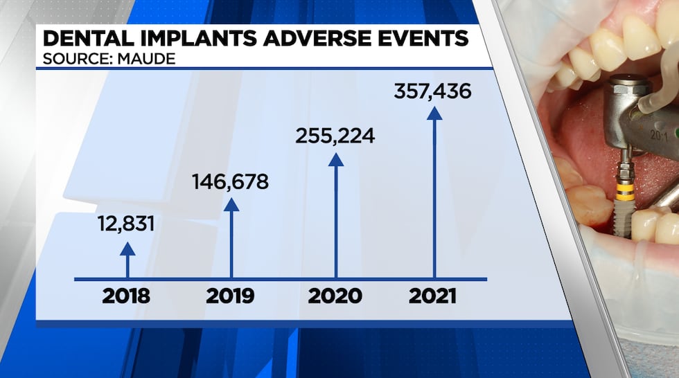 Reports adverse events from dental implants skyrocketed from 2018 to 2021.