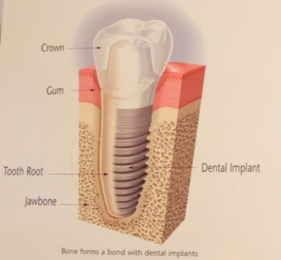 A drawing of what a dental implant looks like